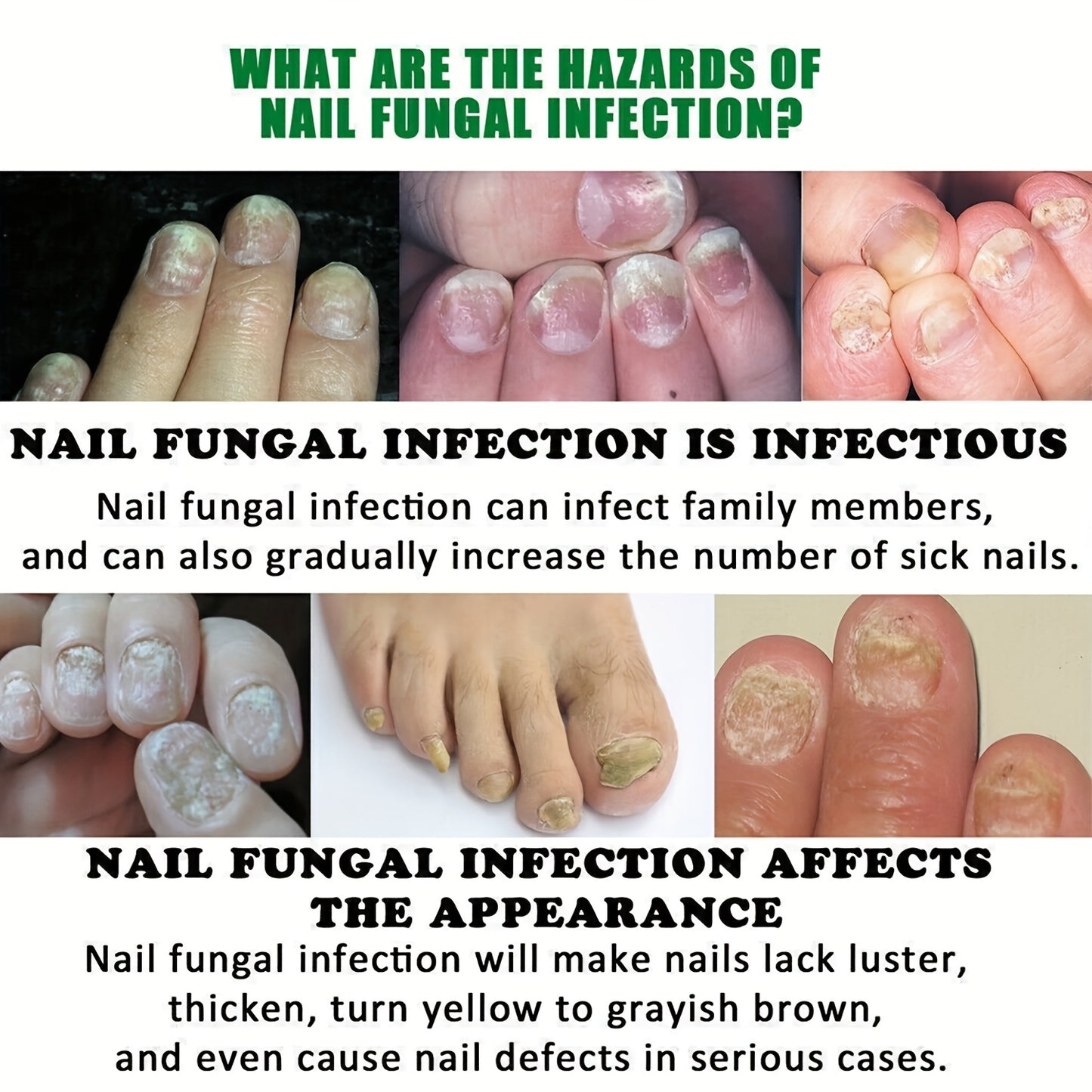 KTS Laser Device for Effective Nail Fungus Treatment and Care